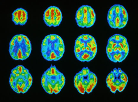 November 1981 --- Color-coded results of a brain scan made while the patient was thinking, from a positron emission tomography scanner